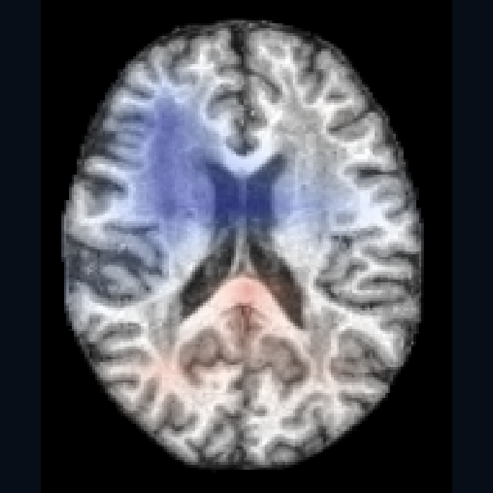OAS1_0030 axial MRI with signed Grad-CAM; not a disease map